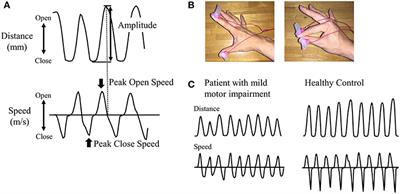 Nigrostriatal Dopaminergic Dysfunction and Altered Functional Connectivity in REM Sleep Behavior Disorder With Mild Motor Impairment